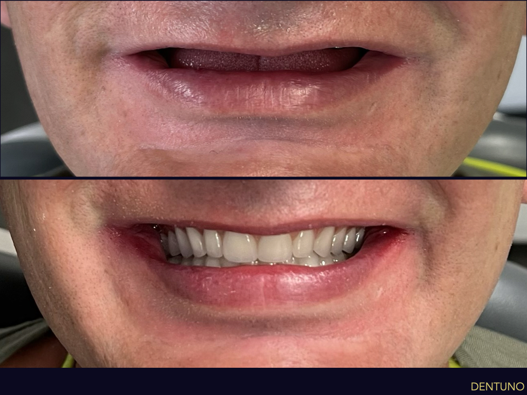 ALL-ON-4_IMPLANT_001.jpeg