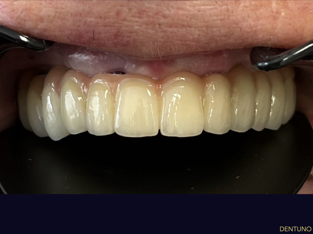 ALL-ON-4_IMPLANT_002.jpeg