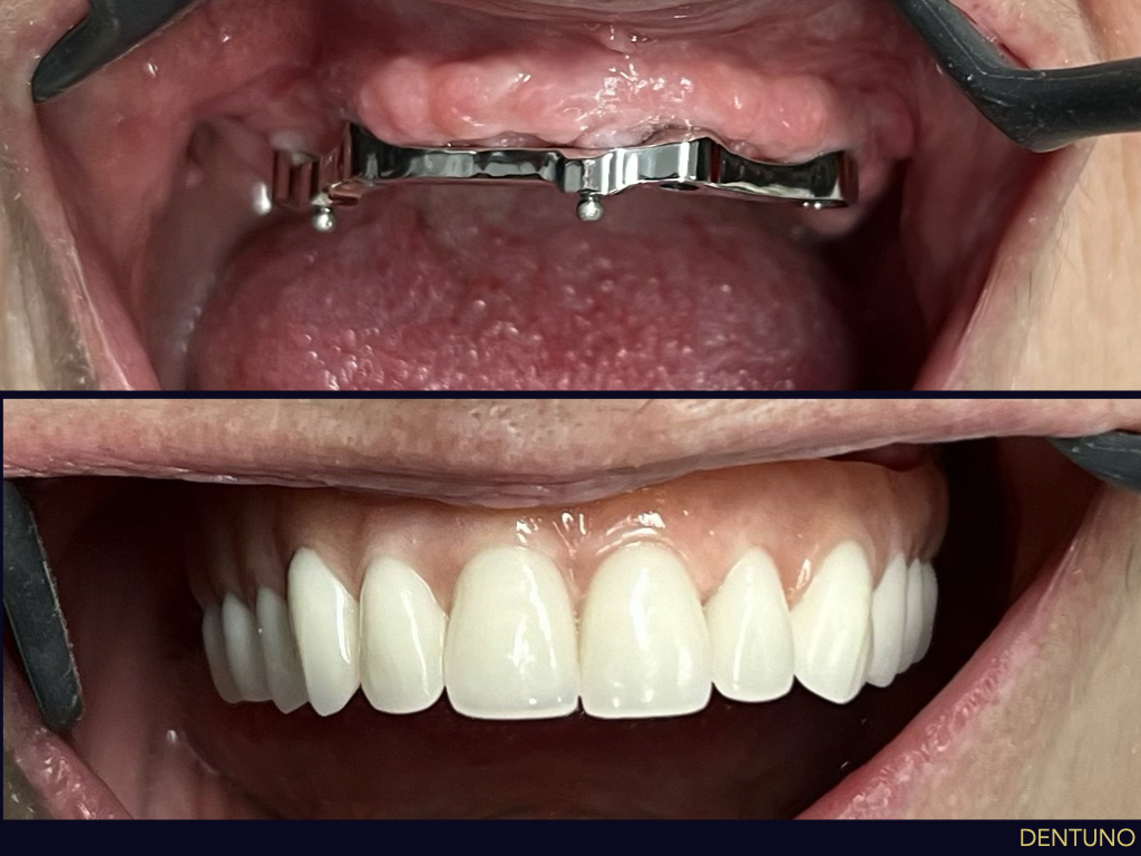 ALL-ON-4_IMPLANT_004.jpeg
