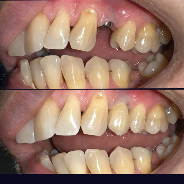 Foghiány pótlása implantátummal