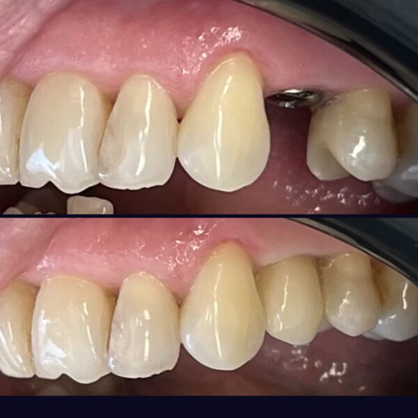 Foghiány pótlása implantátummal