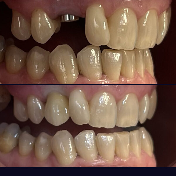Foghiány pótlása implantátummal