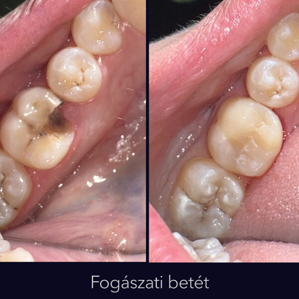 Fogászati betét