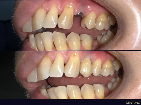 Foghiány pótlása implantátummal