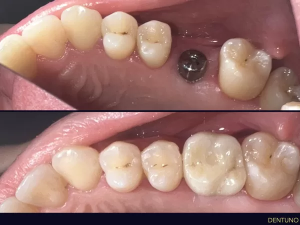 Foghiány pótlása implantátummal