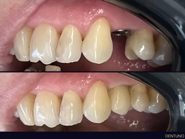 Foghiány pótlása implantátummal