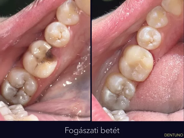 Fogászati betét