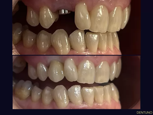 Foghiány pótlása implantátummal